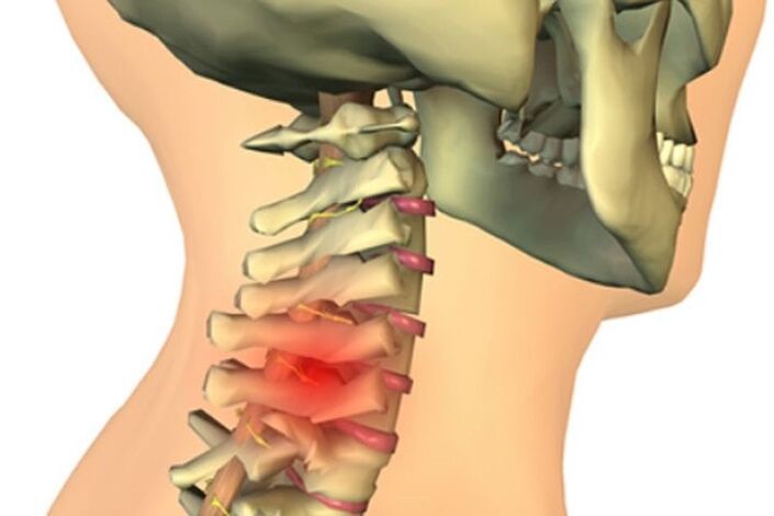 ból szyi z powodu choroby zwyrodnieniowej stawów