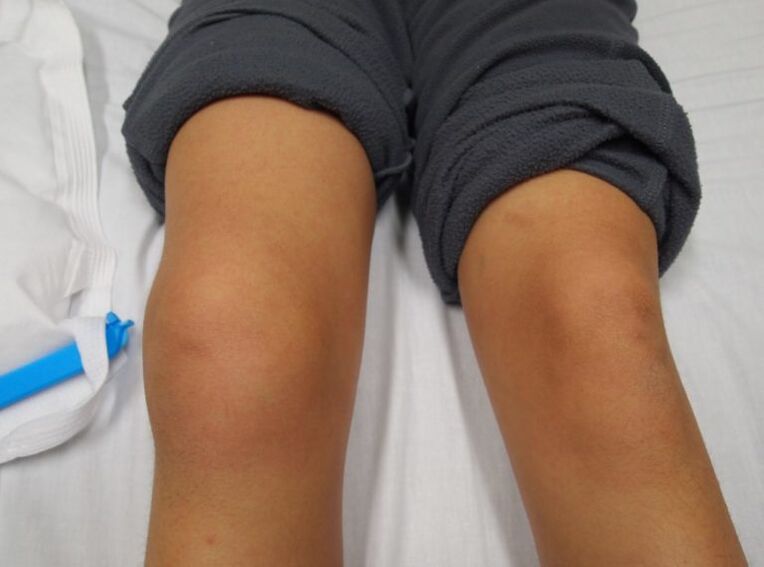 deformacja stawu kolanowego z artrozą